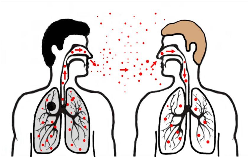 QUÉ ES? La tuberculosis es una infección causada por una bacteria llamada Mycobacterium tuberculosis.