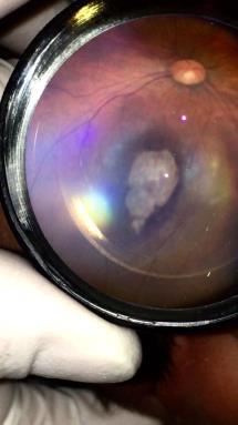 Recomendaciones de SOPLA: En bebés con diagnóstico presuntivo o confirmado de microcefalia se requiere al menos un examen oftalmológico bajo MIDRIASIS