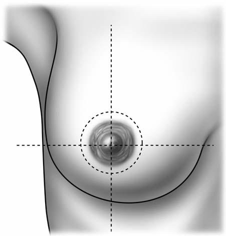 Localización del câncer de mama