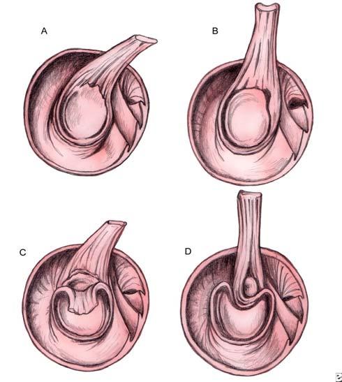 Fig.5 33 Fig. 6 34 Por otra parte, la afectación del rodete en su borde superior se denomina SLAP (Síndrome del Labrum Antero-Posterior).