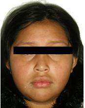 P á g i n a 8 Objetivos del tratamiento de esta paciente son: mantener el perfil facial, corrección del apiñamiento maxilar y mandibular, exposición quirúrgica y tracción del incisivo central