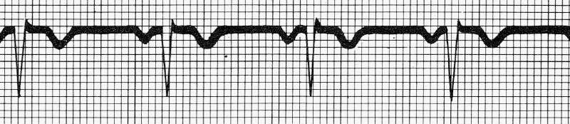 Ritmo cardiaco Lo normal Que sean rítmicos (los intervalos PQRST: idénticos) ritmo sinusal: Cada P va seguida de un QRS. P positiva en II. P negativa en AVR.