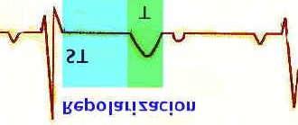 Repolarización ó ST-T Incluye al segmento ST y a la onda T.