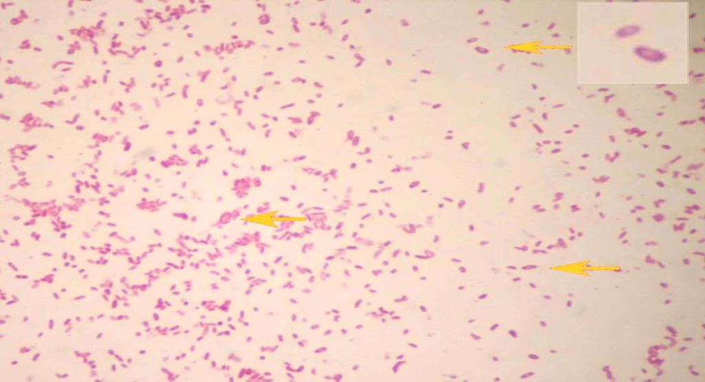 ETIOLOGÍA: Fusobacterium