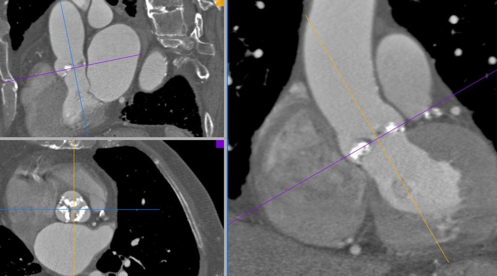 Angio Tomografía Multicorte (64-128 cortes)-gatillada (40% Ciclo Cardíaco)