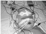 MONITORIZACIÓN El estatus epiléptico puede ser convulsivo o no convulsivo monitorización electroencefalográfica continua El índice biespectral (BIS) es un