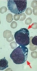 Vacuolización Tipo morfológico L 3 Células grandes y homogéneas Homogénea y en punteado fino