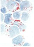 Leucemia/Linfoma de Burkitt - Constituye el 3-5% de las LA en los niños y adultos - PAS negativo - Reacción de Red Oil positiva - Presencia de Igs de superficie - Fenotipo B maduro La forma vista en