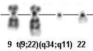 2); BCR/ABL1 p190 Leucemia / Linfoma Linfoblástico B con t(v;11q23); con rearreglo de MLL Leucemia / Linfoma Linfoblástico B con t(12;21)(p13;q22); TEL/AML1