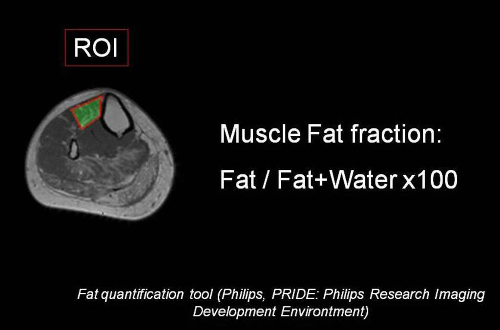 Fig. 5 Tal y como se refleja en la imagen anterior, obtenemos el valor de fracción grasa de cada músculo con esta simple fórmula.
