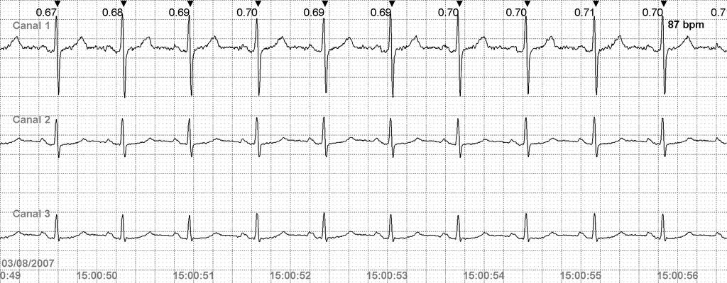 CardioVex Holter Estudio: CLAUDIA ESPINOSA PADIERNA 03/08/2007 extrasístole ventricular interpolada 25 mm/seg, 0 mm/mv