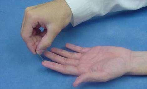 Exploración de Mano Edema de mano Aumento de la tensión Dolor a los movimientos pasivos de los dedos.