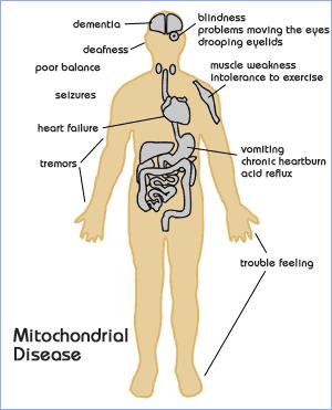 Enfermedades asociadas a herencia mitocondrial - Miopatía mitocondrial - Neuropatía óptica de Leber - Síndrome de Leigh
