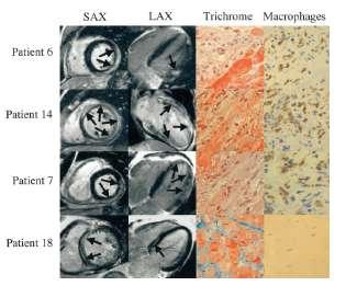 Cardiovascular Magnetic Resonance Assessment of Human Myocarditis A Comparision to Histology and Molecular Pathology SAX LAX