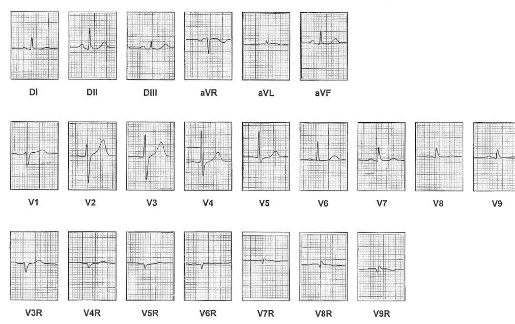 Figura 5. Electrocardiograma de 12 derivaciones y círculo torácico obtenidos en una persona sana Derivaciones V7R a V9R El paciente debe adoptar la posición de decúbito lateral izquierdo.