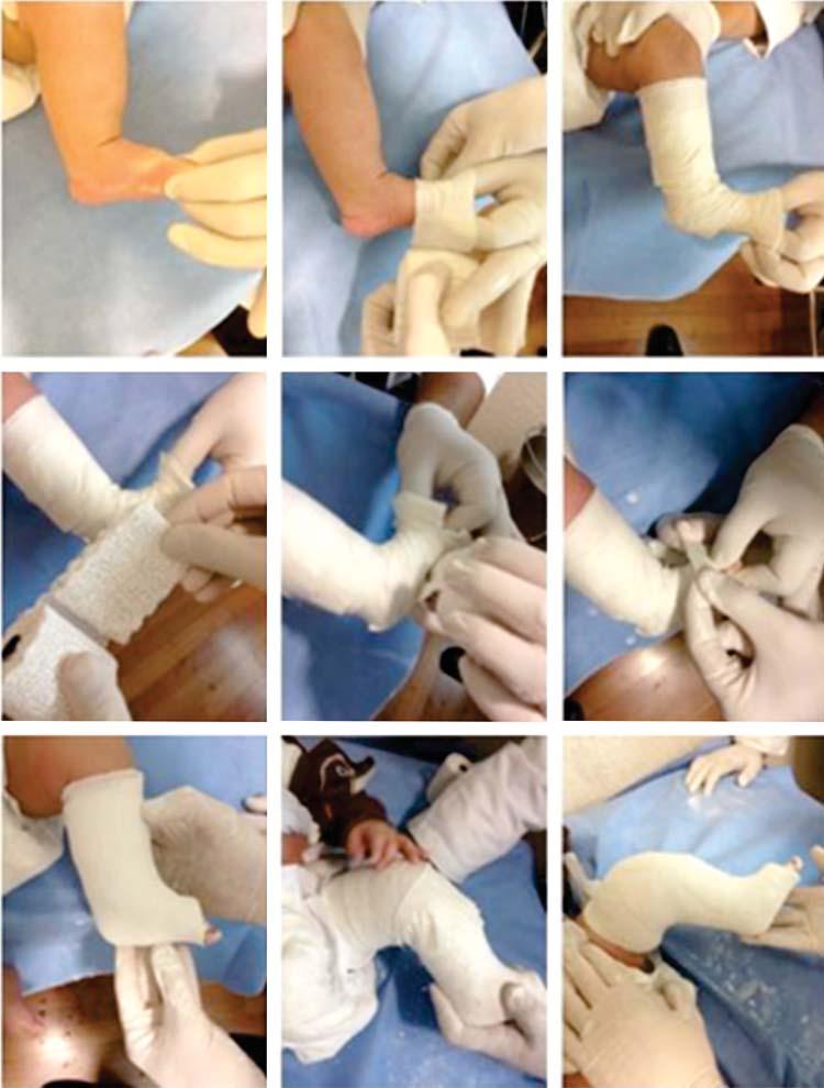 El pie equino varo aducto congénito (PEVAC) es la segunda patología ortopédica más común en la infancia.