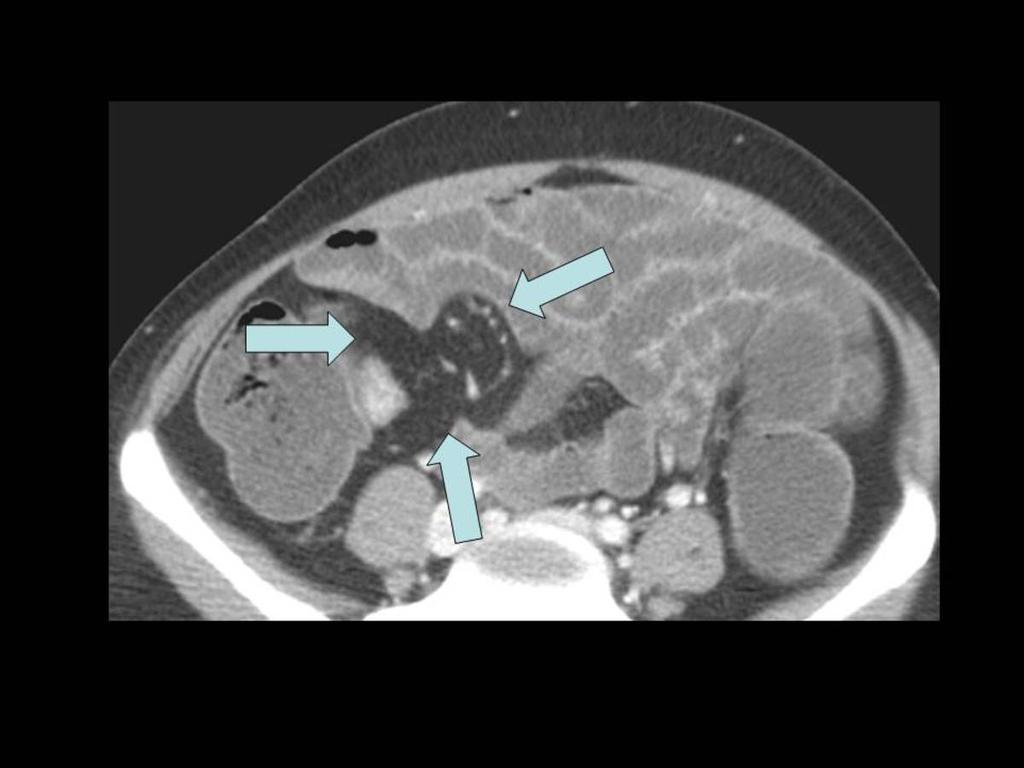 Fig. 17: Proliferación fibrograsa mesentérica.