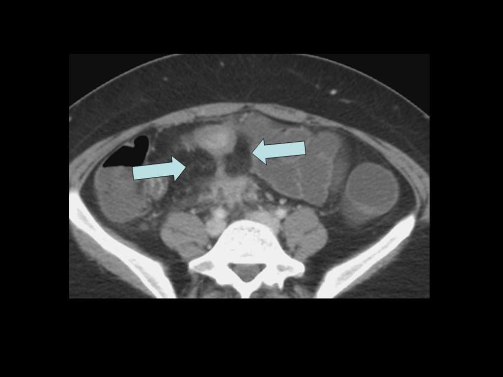 Fig. 21: Enfermedad de Crohn con patrón fistulizante.