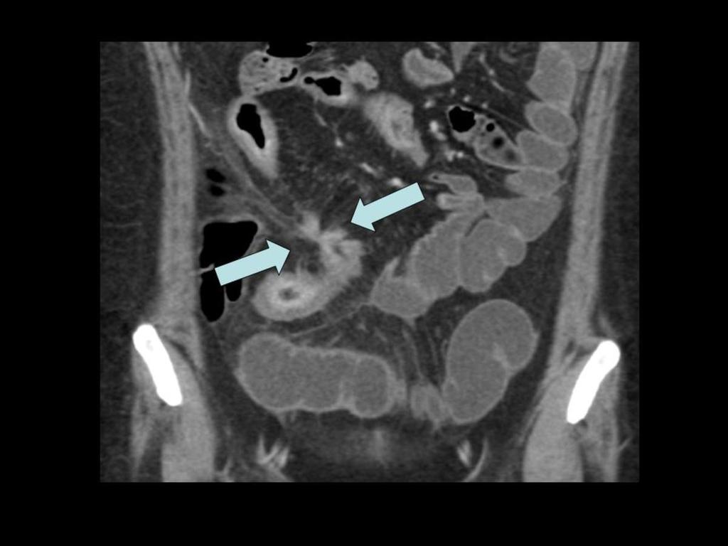 Fig. 22: Enfermedad de Crohn con patrón fistulizante.