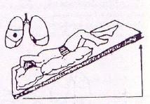 d) Lateral izquierdo con almohadas debajo de la cabeza y el brazo derecho extendido sobre la cabeza, gire el tronco 90 grados hacia atrás con almohadas debajo del cuerpo.