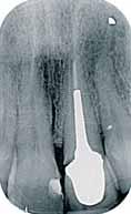 Confirmamos la movilidad y la fractura de la raíz. Planificamos retirar la prótesis, extraer la raíz fracturada, colocar un implante Xive 4.