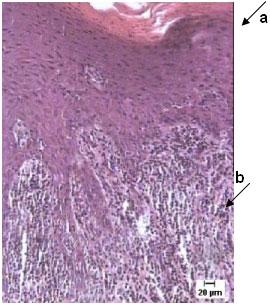 Fig. 1: Epitelio paraqueratósico (a) de la mucosa con infiltrado inflamatorio severo (b) y curalavos interpapilares deformados. Coloración H/E. 200 X.
