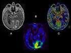Neuroimágenes: espectroscopía, RM