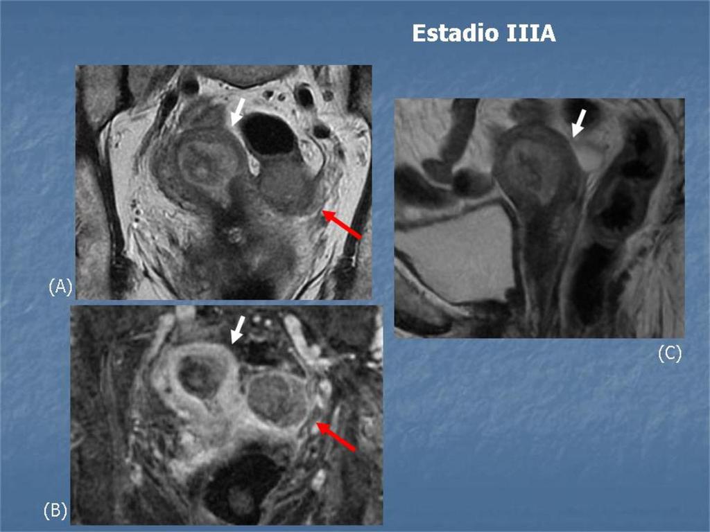 Fig. 7: Carcinoma de células claras estadio IIIA. Secuencias coronal (A) y sagital (C) T2 y axial T1 poscontraste con saturación grasa (B).