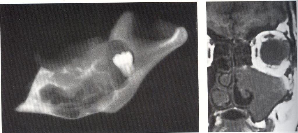 Exploraciónes radiográficas Hemi-mandibulectomía por ameloblastoma multiquístico,