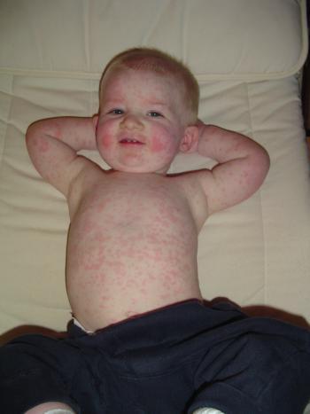 los 4-7 días enfermedad conocida como eritema infecioso o síndrome de la