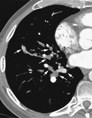 80 Webb & Higgins Radiología pulmonar y cardiovascular Figura 3-19. Carcinoma polipoide de células escamosas (*) surgiendo de la tráquea distal.