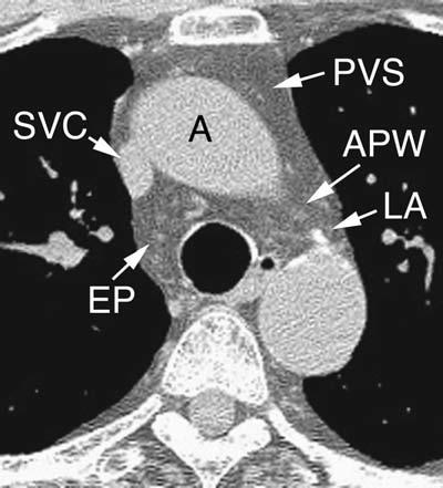 de la arteria pulmonar izquierda.. Imagen con ventana pulmonar, al mismo nivel que. Es visible la carina traqueal (Car).