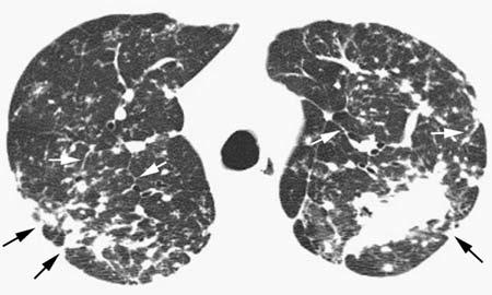 . La TCR de los lóbulos superiores muestra múltiples nódulos pulmonares de pequeño tamaño que afectan al pulmón de forma parcheada.
