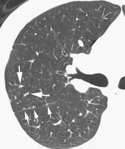 En los pulmones posteriores se observa la confluencia de múltiples nódulos peribroncovasculares. C.