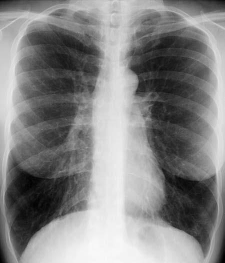 570 Webb & Higgins Radiología pulmonar y cardiovascular C D E Figura 25-9. Linfangiomiomatosis.