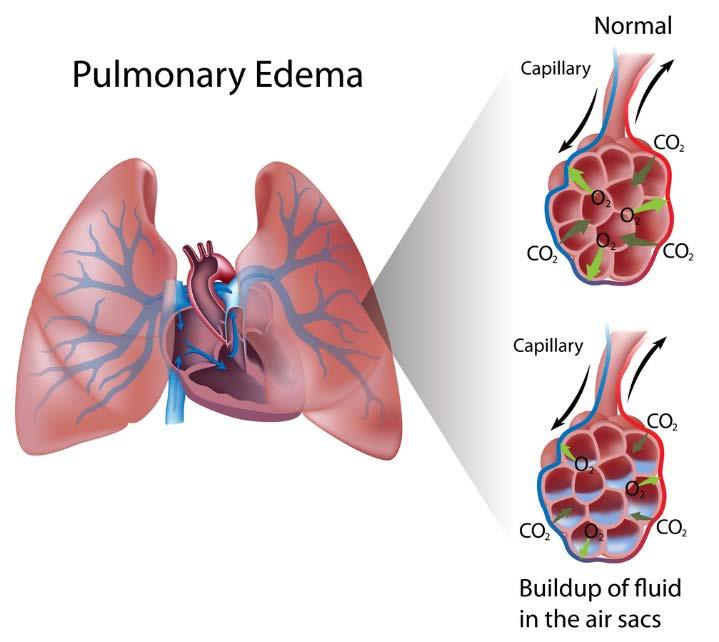 Estertores pulmonares difusos. Se puede oír un ruido de burbujeo durante la respiración (edema pulmonar).