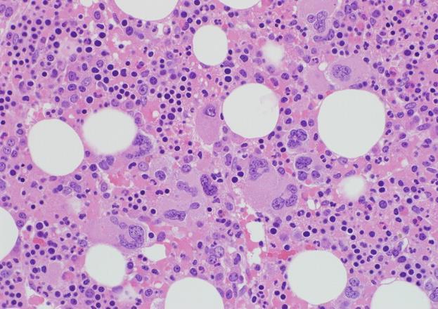 POEMS: Biopsia con cluster de megacariocitos