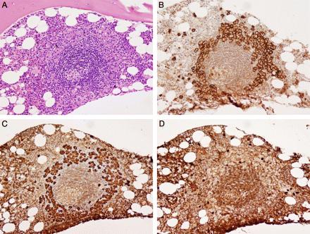 POEMS: Agregados linfoides en Biopsia CD138+ LAMBDA+