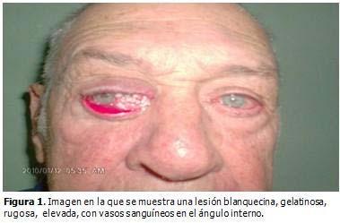 neoplasms; ophthalmologic surgical procedures Limits: Humans; adult INTRODUCCIÓN La conjuntiva es una capa de revestimiento epitelial del ojo; de cualquiera de sus componentes histológicos pueden