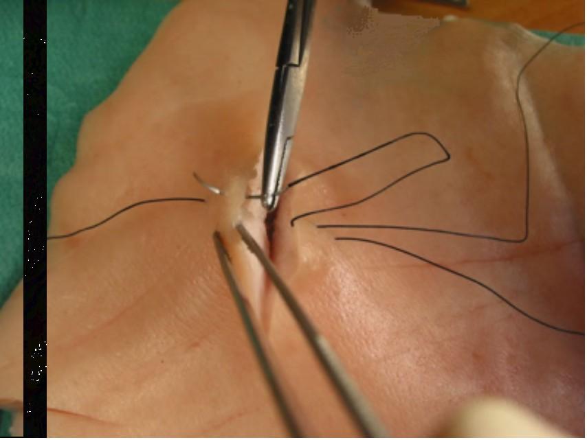 Punto de colchonero vertical Trayecto superficial de la sutura (vuelta: cerca-cerca)