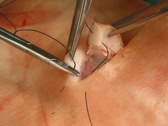 Punto de colchonero horizontal semienterrado Trayecto de vuelta de la sutura Entrada y salida de la