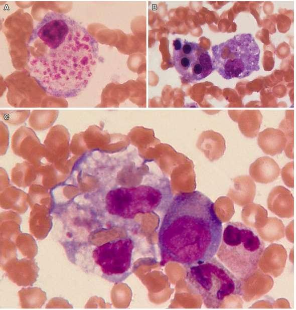 DIAGNÓSTICO 15-30% SHF con AMO (-) Hemofagocitos en sepsis Hemophagocytic