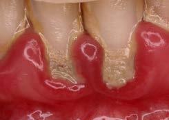 Historia clínica Diagnóstico periodontal: conceptos básicos Exploración periodontal Textura//Color//Contorno.
