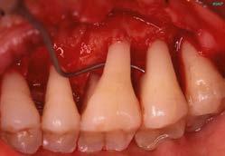 Historia clínica Exploración periodontal Lesiones de furcación : Sondaje Anatomia dental.