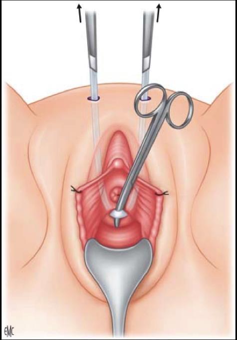 Sling suburetral tipo TVT: La disección suburetral se hace en dirección craneal y lateral, hacia la espina ilíaca anterosuperior.