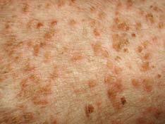 Ocasionalmente la leishmaniosis produce nódulos de aspecto tumoral situados en la dermis.