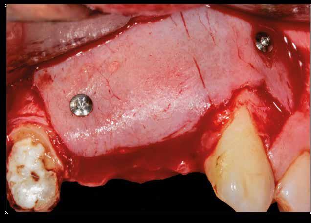 La barrera OsteoBiol Lamina Curva tiene una consistencia semirrígida y puede ser injertada sin hidratación, para que su forma se adapte a la morfología del defecto.