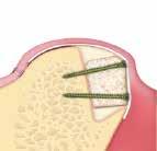 Bloque rígido Sp-Block Soporta la formación de nuevo hueso Bloque rígido 100% hueso esponjoso OsteoBiol Sp-Block soporta la formación de nuevo hueso: gracias a su consistencia rígida y a su forma, es