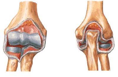 complicații după boală pe articulația șoldului traumatism la cornul meniscului articulației genunchiului