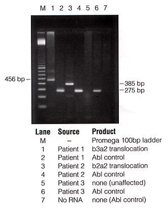 Leucemia Mieloide Crónica (LMC) Diagnóstico (fase crónica) Médula ósea o sangre periférica (con EDTA) Biología molecular para gen de fusión Bcr/Abl (RT-PCR) GRADO 2 GRADO 3 La presencia del